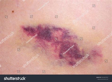 Skin Bruise Images Stock Photos And Vectors Shutterstock
