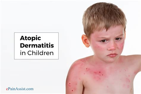Atopic Dermatitis In Children Symptoms Causes Diagnosis Treatment
