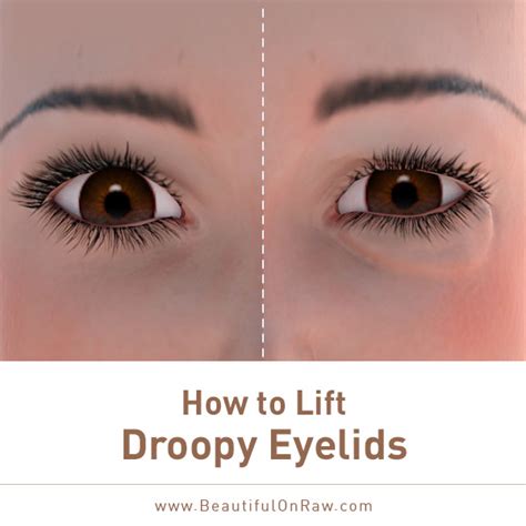 Nov 01, 2015 · a commonly used prescription eye drop to treat droopy eyelids resulting from botox treatments is iopidine (apraclonidine). How to Lift Droopy Eyelids | Beautiful on Raw