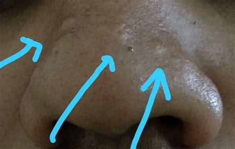 How Can I Treat Hypertrophic Scars On Nose Hypertrophic Raised Scars Forum