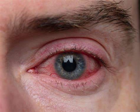 What Causes Bloodshot Eyes Vision Direct Au