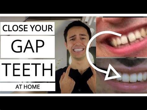How to close a gap in your teeth at home in hindi. DIY: Close Gap Teeth in 40 DAYS under $5 (EASY!) - YouTube ...