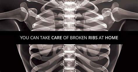 How To Get Relief When You Have Fractured Ribs