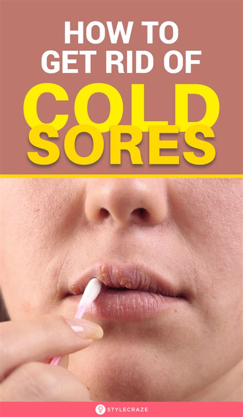 How To Get Rid Of Cold Sores 20 Home Remedies And Other Treatments