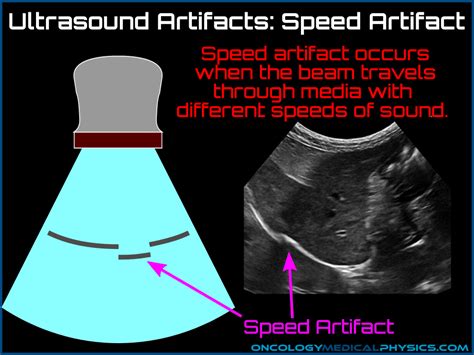 Ultrasound Artifacts Oncology Medical Physics