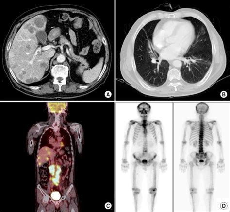 Multiple Metastatic Prostate Cancer In The Patient A Abdomen And