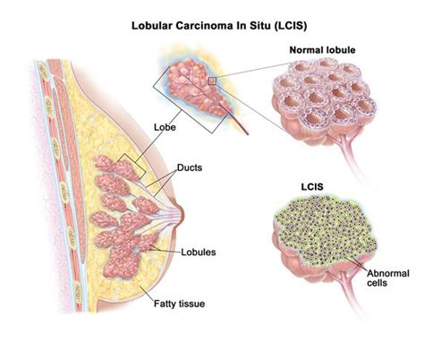 In stage ia, cancer has not yet spread outside the breast, and the tumor is 2 centimeters or smaller. Breast Cancer Pictures | New Health Guide