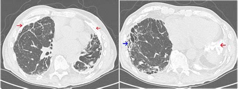 Severe Case Of Asbestos Related Lung Diseases Bmj Case Reports