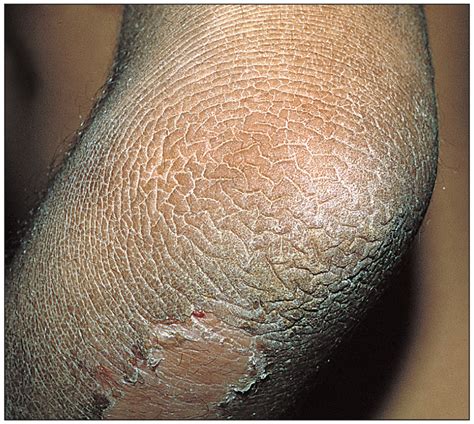 Ichthyosis Bullosa Of Siemens A Topical Therapy Option Congenital