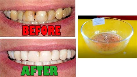 Magical Teeth Whitening Remedy Get Whiten Teeth At Home In 5 Minutes