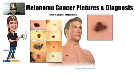 Spotting Melanoma Cancer And Symptoms With Pictures Youtube