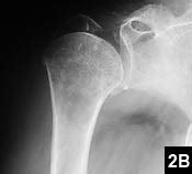 Current Concepts in the Treatment of Proximal Humeral ...