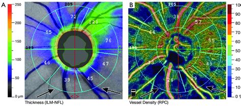 Optic Nerve Head And Peripapillary Optical Coherence Tomography
