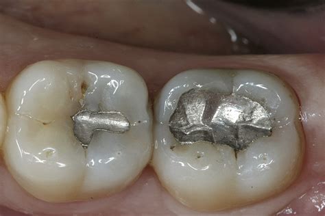 Amalgam Vs Composite Amalgam Composite Decision Bandacruise