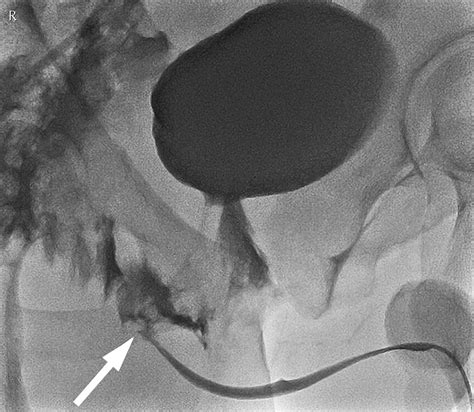 Complete Posterior Urethral Disruption Accompanied By Complex Pelvic