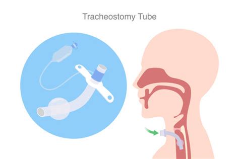 Tracheostomy Anatomy Illustrations Royalty Free Vector Graphics And Clip
