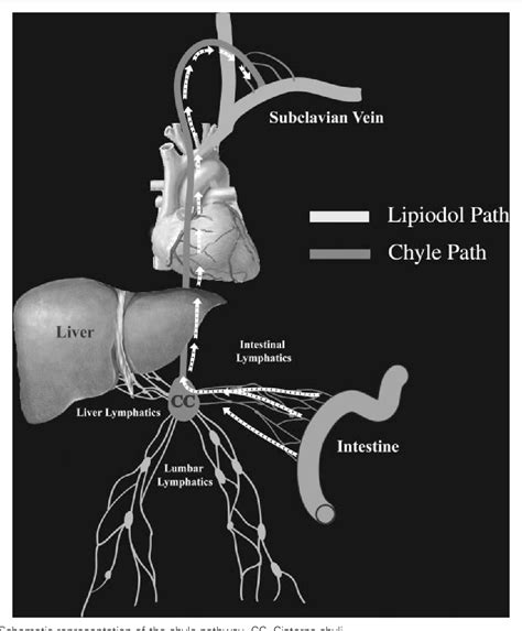 Figure 6 From Thoracic Duct Embolization For Chylous Leaks Semantic