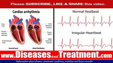 Types Of Irregular Heart Rhythm Best Design Idea