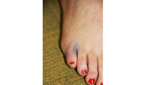 Phalangeal Fracture Country Foot Care