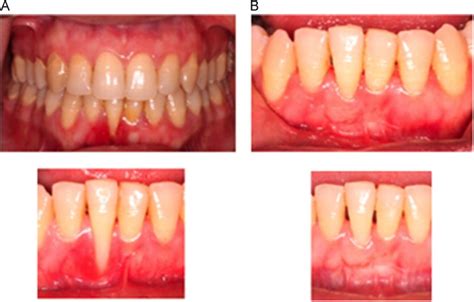 Management Of Gingival Recession In The Orthodontic Patient Seminars