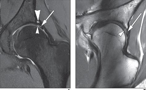 Mri Of Labral And Chondral Lesions Of The Hip Semantic Scholar