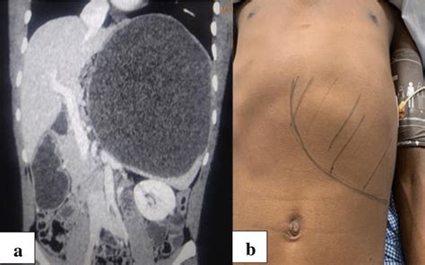 A And B Preoperative Images Of The Splenic Cyst And Cect Image Of