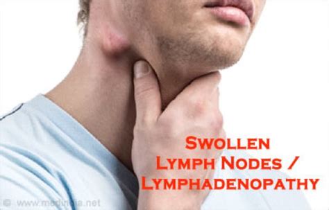 Lymphadenopathy Enlarged Lymph Nodes Causes Definition Types