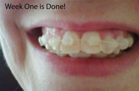 My Six Month Smile Blog Week One In Braces