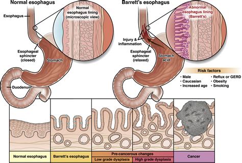 Barrett S Esophagus Clinical Gastroenterology And Hepatology