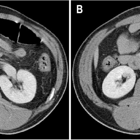 Contrast Enhanced Abdominal CT Scan Findings A A Intimal Flap In The
