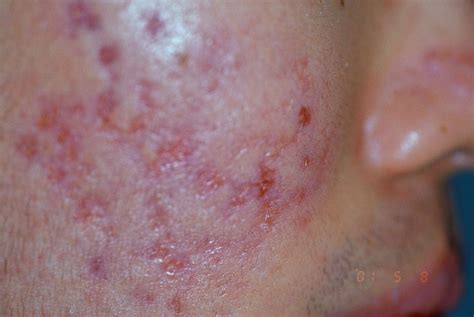 Also called pitted acne scars, they are a type of atrophic scarring (scars caused by a loss of tissue) and include ice pick scars, boxcar scars, and rolling scars. Acne Pictures - Index