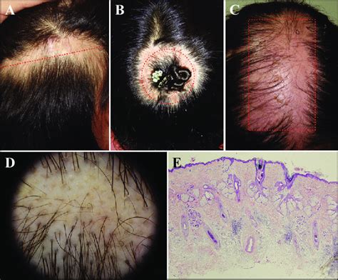 A C Clinical Images Of Lupus Erythematosus Panniculitis Lep Of The