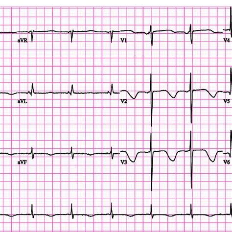 Initial ECG Shows Sinus Rhythm With Deep T Wave Inversion And