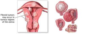 Sekitar empat dari 10 wanita di atas usia 40 tahun akan memiliki fibroid. Diagnosa Dan Komplikasi Fibroid Rahim / Uterine Fibroids ...