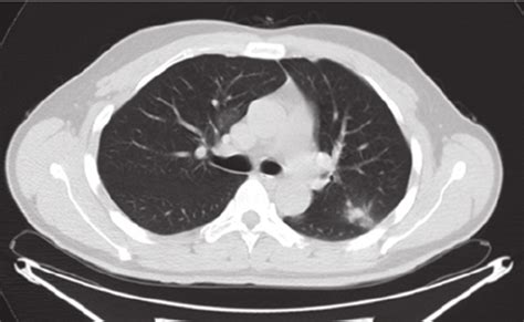 Ct Scan Of The Chest Demonstrates A Sub Pleural Nodule In The Left My