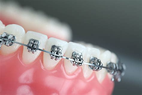 Self Ligating Braces Now Orthodontics