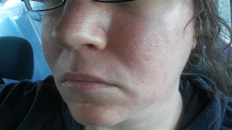 [Skin Concern] I've never met anyone with skin texture / pores as bad ...