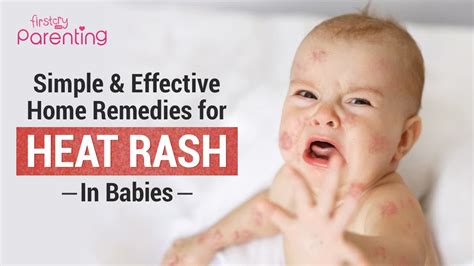 8 Simple Home Remedies For Heat Rash On Babies Youtube