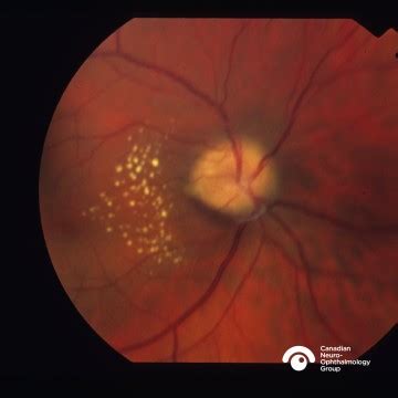 aion macular starcanadian neuro ophthalmology group