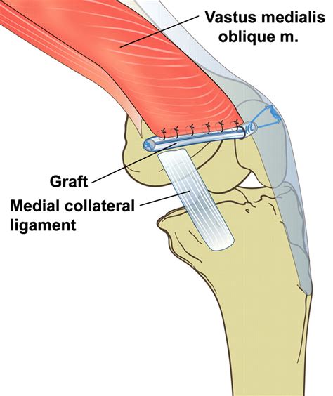The Docking Technique For Medial Patellofemoral Ligament Reconstruction