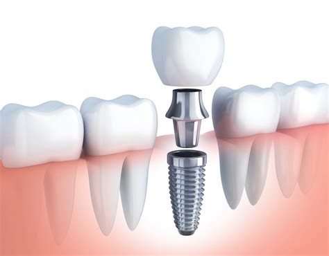 Todo Lo Que Debes Saber Sobre Los Implantes Dentales Clínica Dental