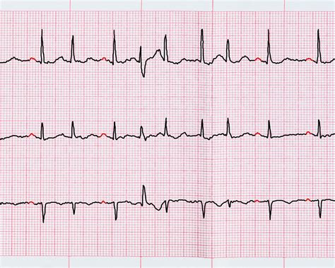 Atrial Fibrillation Fulminant Myocarditis Observed In Adolescent With