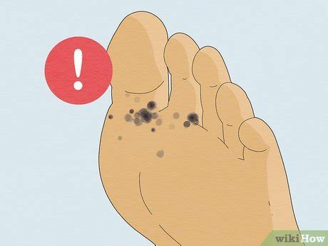 How To Treat Sand Flea Bites Soothe Itchy Irritated Skin Fast