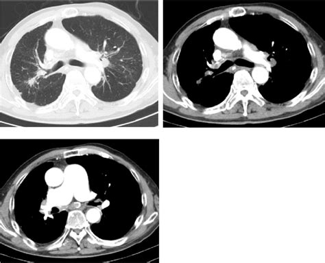 Chest Ct Images Showing Mediastinal And Hilar Lymphadenopathies With