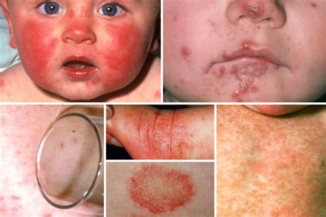 From Meningitis To Eczema And Measles The Ultimate Baby Rash Guide