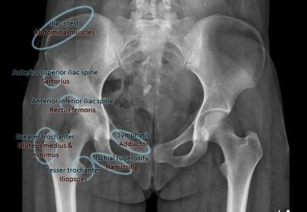 Pelvic fractures | Radiology Reference Article | Radiopaedia.org