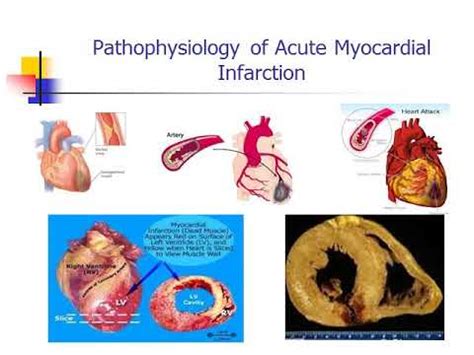 Glomerulonephritis (glomerular nephritis , gn) denotes group of primary and secondary acute and chronic kidney diseases (usually affecting both kidneys) mostly characterised by immune. Acute Coronary Syndrome ACS Lecture 1 | Cardiology | 5th ...