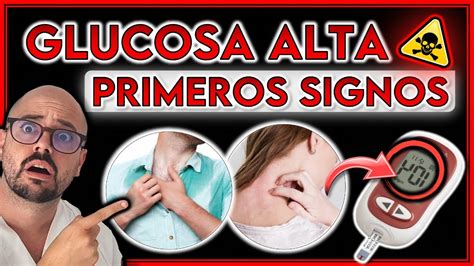 S Ntomas Que Avisan De Glucosa Alta Tienes Una Diabetes Youtube