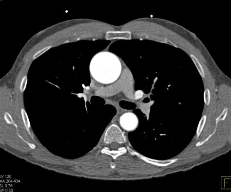 Aortic Stenosis With Calcified Bicuspid Aortic Valve Vascular Case
