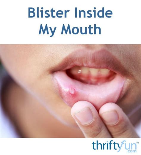 Treating A Blister Inside My Mouth Mouth Ulcer Home Remedy Mouth